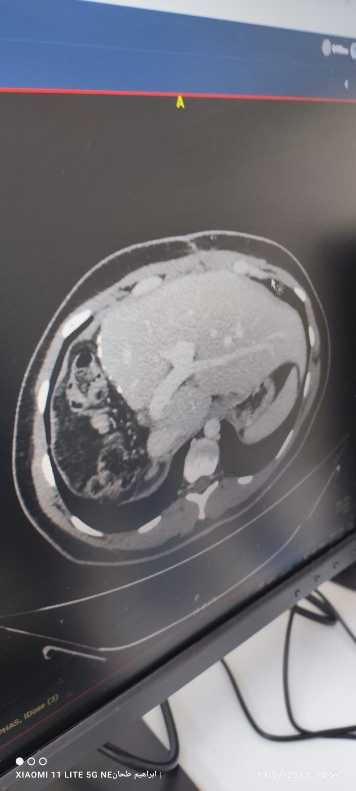 CT Scan of Liver After Donation